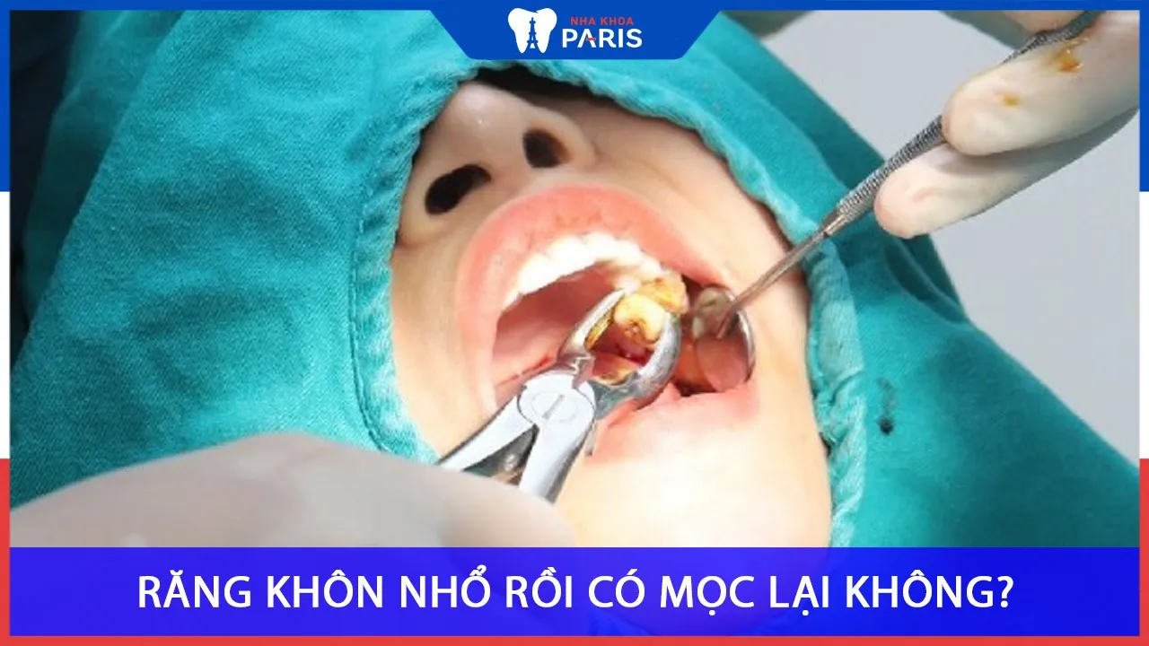 Răng khôn nhổ rồi có mọc lại không? Cách xử lý răng khôn mọc lần 2