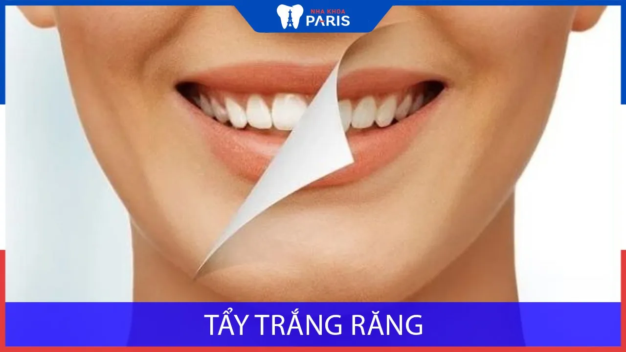 Tẩy trắng răng: Ưu điểm, quy trình và chi phí khi thực hiện