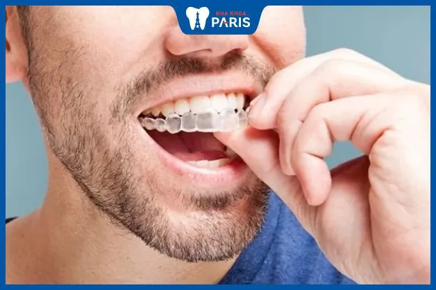 1001 kinh nghiệm niềng răng Invisalign không nên bỏ qua