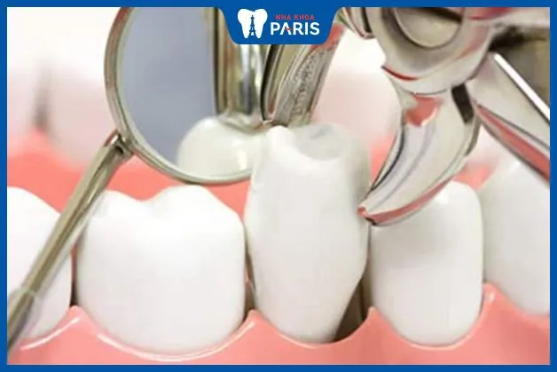 Góc giải đáp: 14 Tuổi nhổ răng hàm có mọc lại không