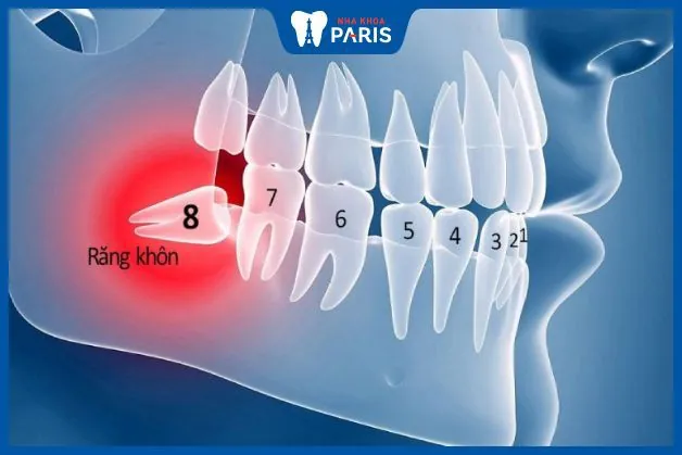 16 Tuổi nhổ răng khôn – Những điều quan trọng ai cũng nên biết