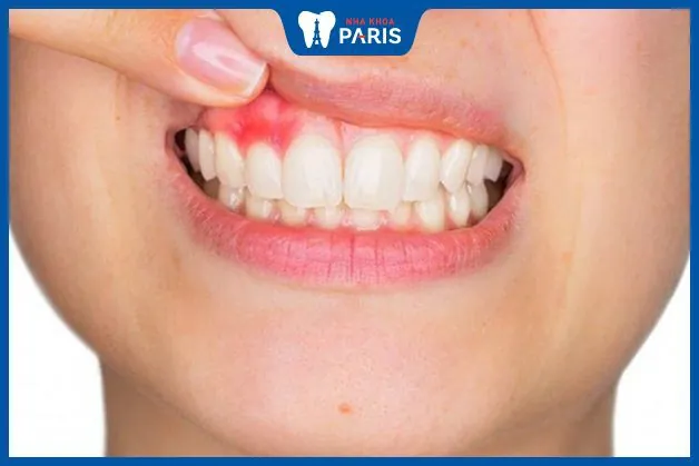 13 Cách chữa viêm nướu răng dân gian tại nhà dễ làm