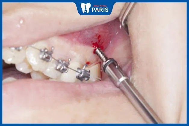 Chảy máu chân răng khi niềng: Nguyên nhân và cách hạn chế