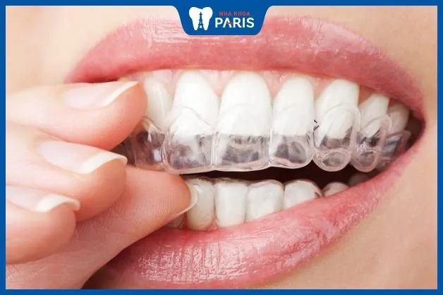 Vì sao đeo hàm duy trì vẫn bị chạy răng: Giải pháp nhanh chóng