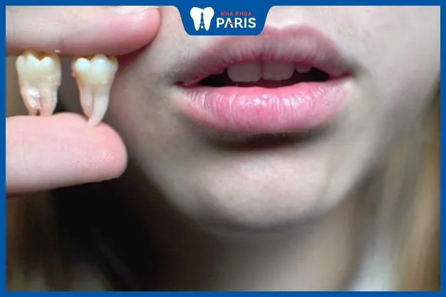 Giải đáp thắc mắc: Tự nhổ răng hàm trên có nguy hiểm không