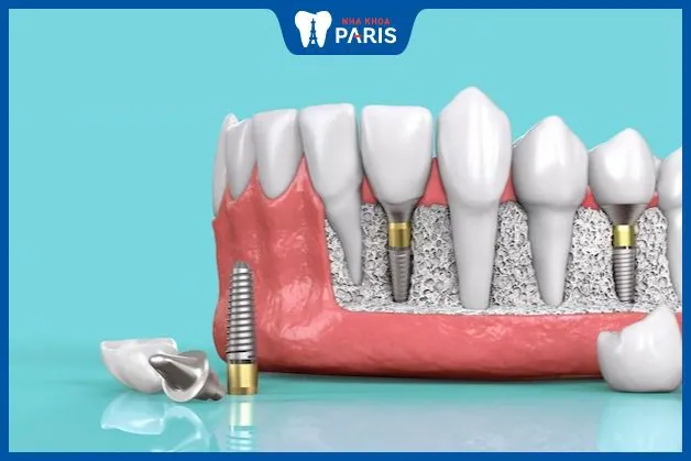 Góc giải đáp: Trồng răng Implant có chụp MRI được không