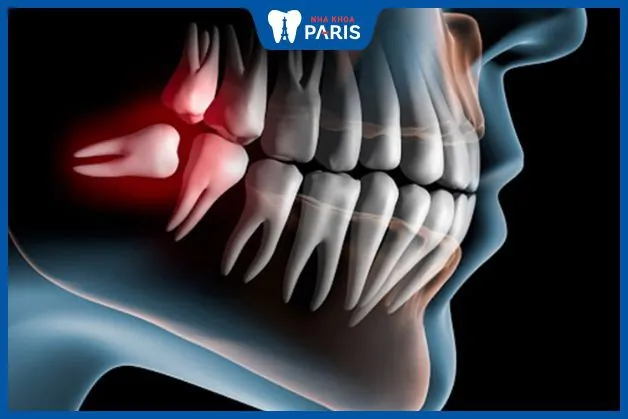 Bỏ túi kinh nghiệm nhổ răng khôn cực “đắt giá”