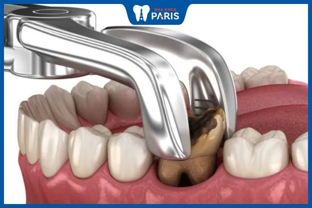 Nhổ răng hàm dưới có đau không – 5 tips giảm đau nhanh chóng