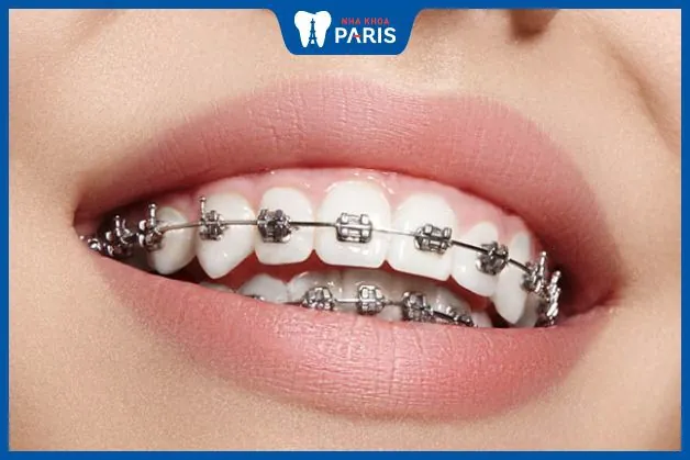 Niềng răng mắc cài kim loại trả góp siêu nhanh