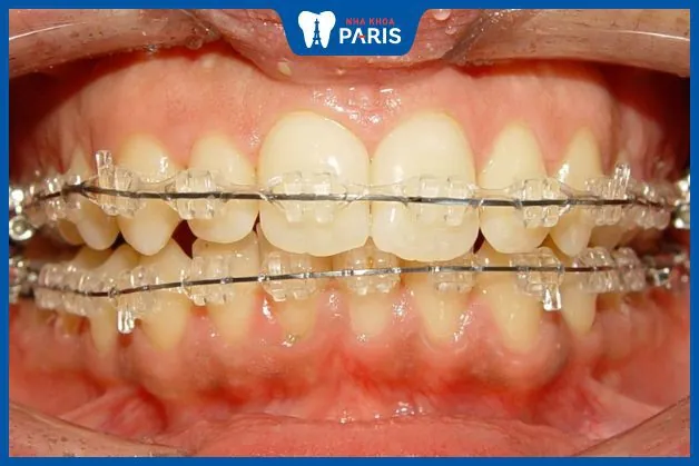 Niềng răng mắc cài sứ cho trẻ em có tốt không – 2 loại phổ biến