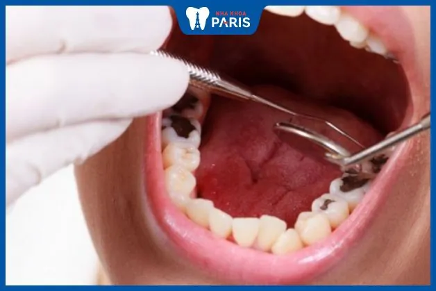 Răng trám bị xỉn màu – Những cách khắc phục siêu hiệu quả
