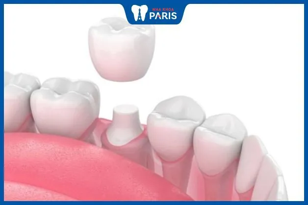 7 Tiêu chí đánh giá địa chỉ bọc răng sứ tại Hải Phòng bạn cần biết