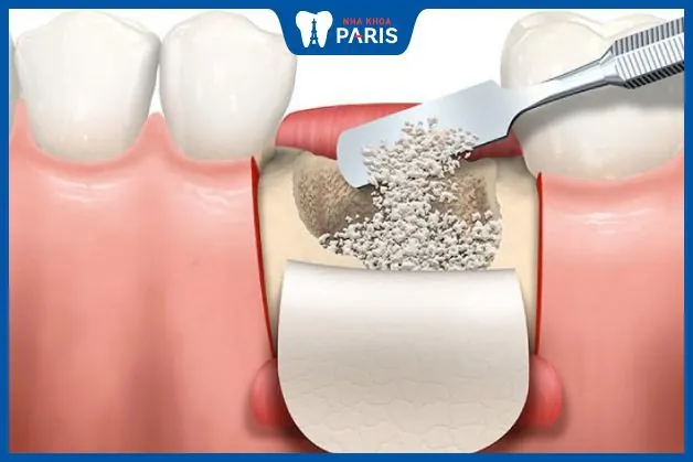 Tầm quan trọng của Chế độ ăn sau Ghép xương: Chỉ dẫn và Lưu ý
