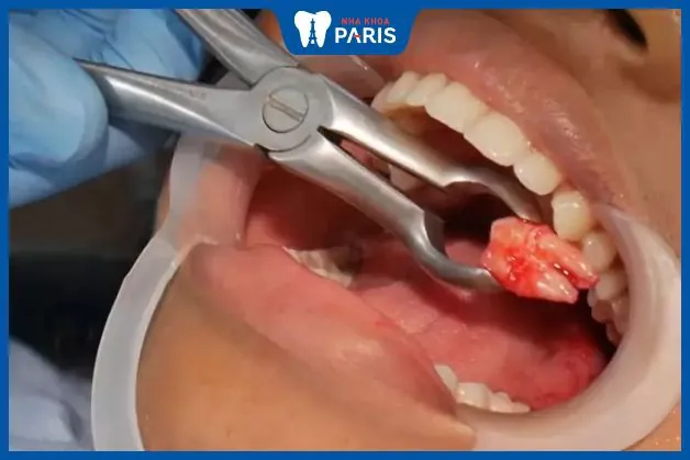 Feedback nhổ răng khôn của khách hàng tại Nha Khoa Paris