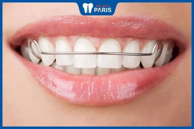 Kỹ thuật Hàm duy trì bằng sắt: Cách thực hiện và Hiệu quả