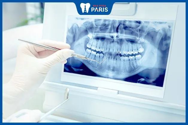 Chẩn đoán viêm tủy răng thông qua hình ảnh X-quang