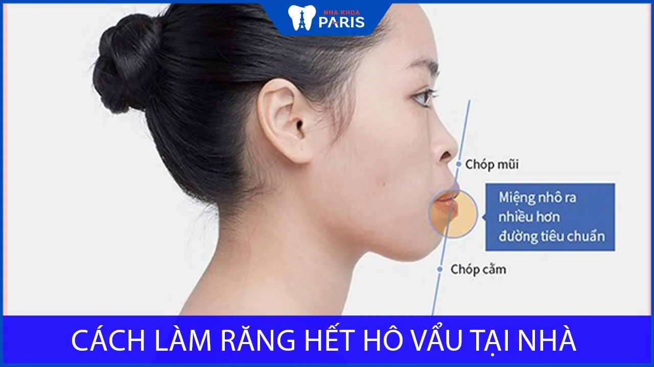 3 Cách làm răng hết hô vẩu tại nhà hiệu quả nhất