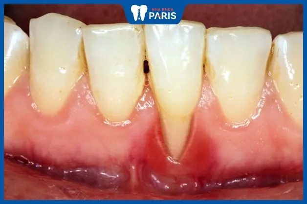 Nhổ răng cửa có nguy hiểm không? Những thông tin nên biết
