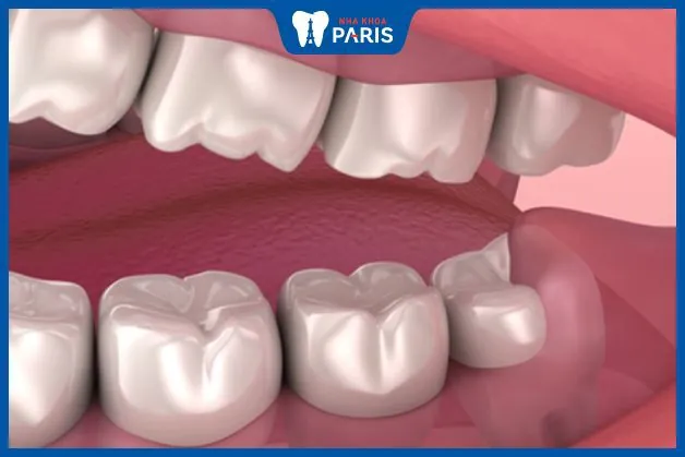 Có nên nhổ răng số 8 mọc thẳng không – Bác sĩ nha khoa giải đáp