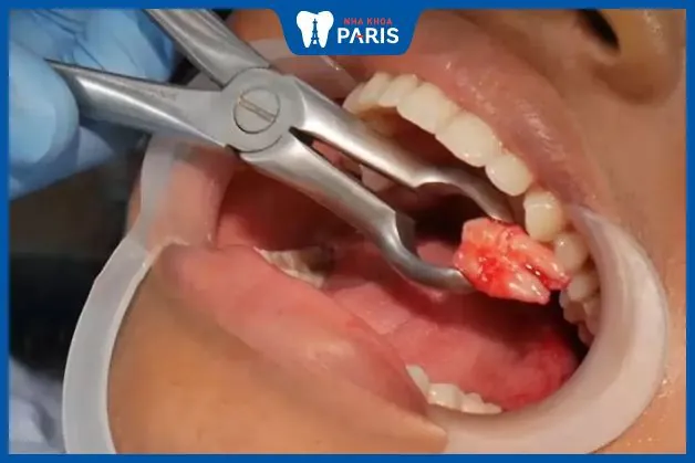 Những món ăn cho người mới nhổ răng khôn không nên bỏ qua