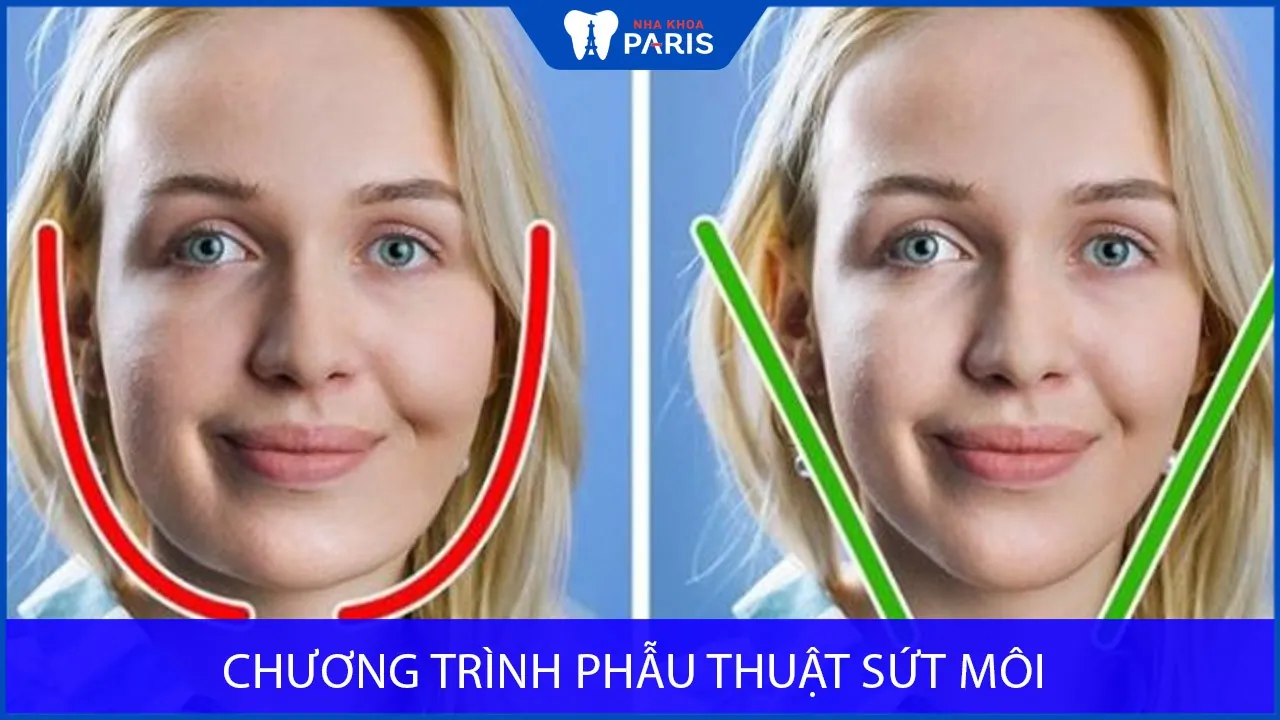 Mewing là gì? Bí quyết thon mặt , Bác sĩ nha khoa tư vấn