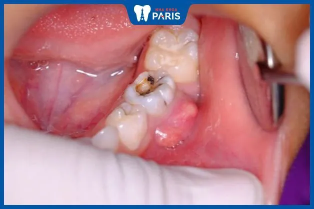 Răng số 7 bị sâu có nên nhổ không – Giải đáp từ bác sĩ nha khoa