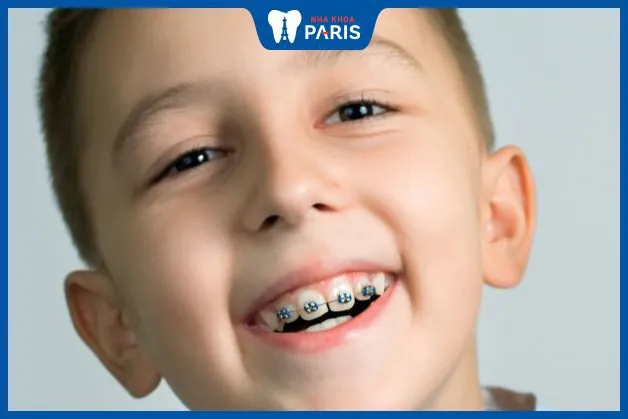 Quyết định của Phụ huynh: Trẻ em có nên niềng răng hay không?