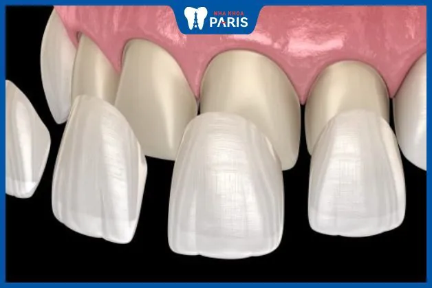 Dán mặt sứ răng Veneer: 90% khách hàng hài lòng với kết quả