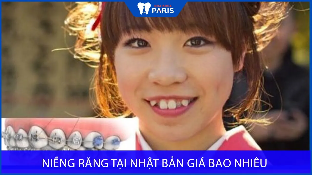 Niềng răng ở Nhật giá bao nhiêu? Mức chênh lệch với VN