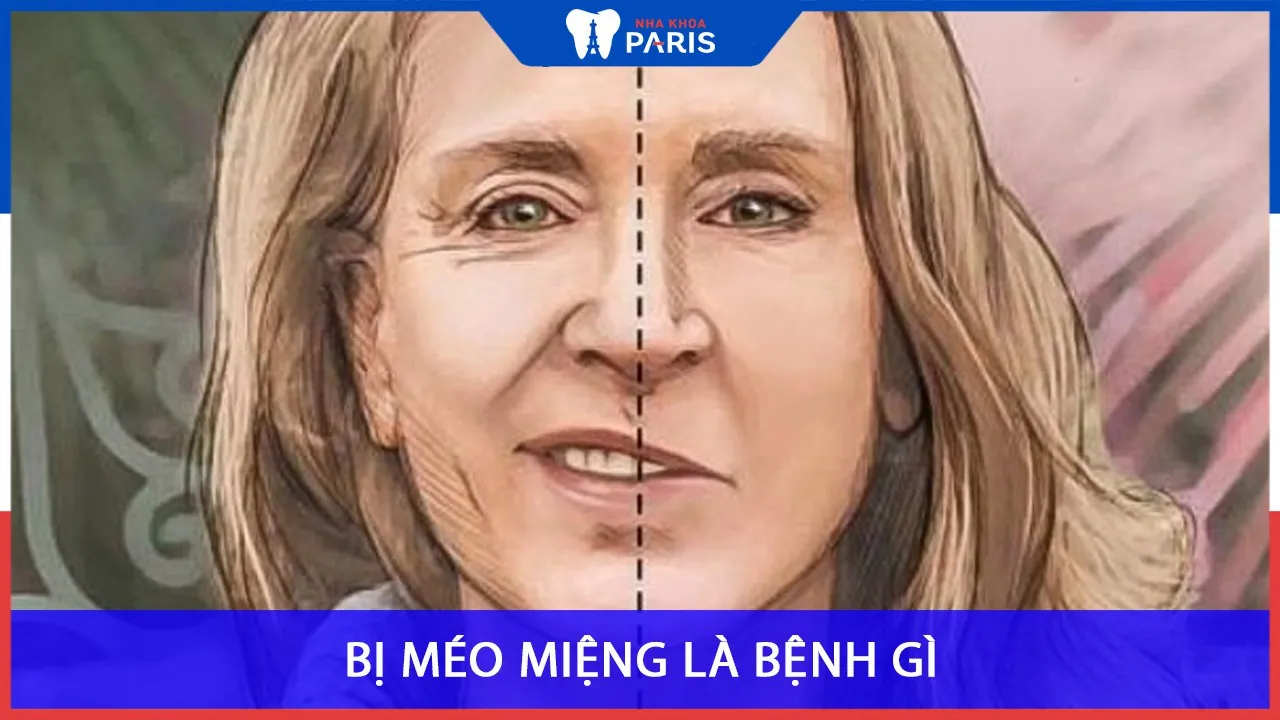 Bị méo miệng là bệnh gì? Cách khắc phục hiệu quả