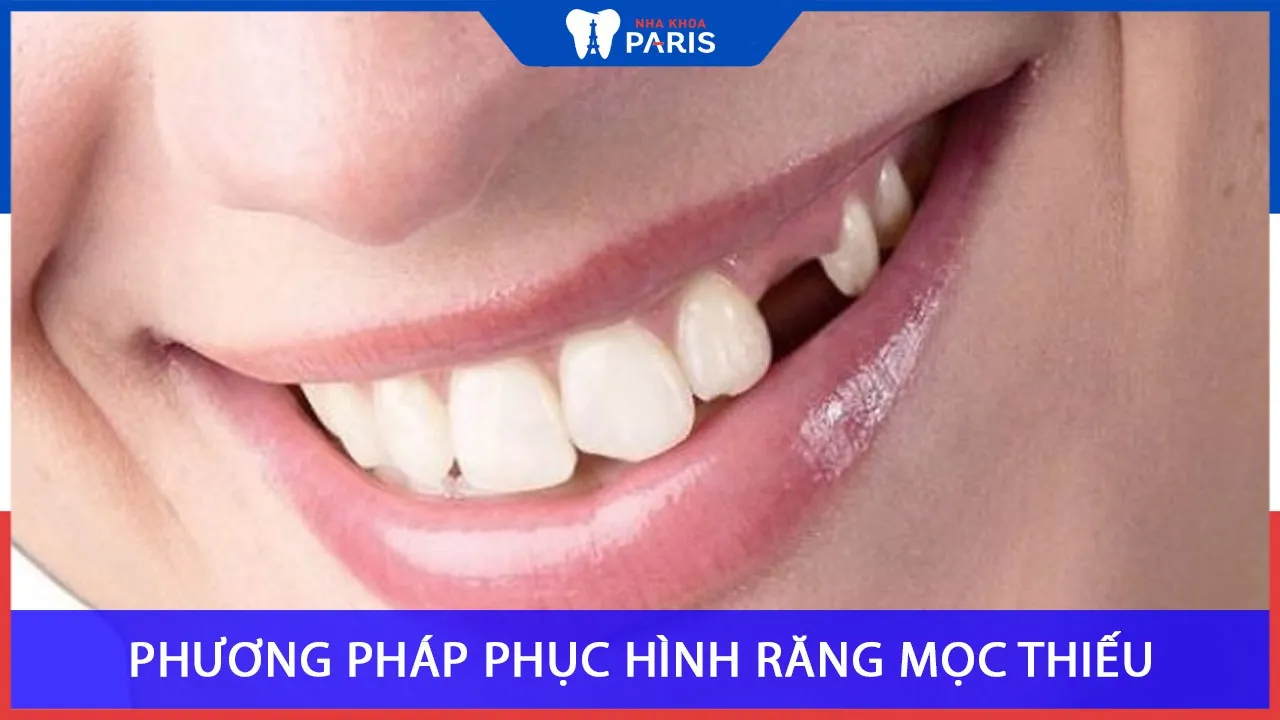Mọc Thiếu răng: phương pháp phục hình răng mọc thiếu
