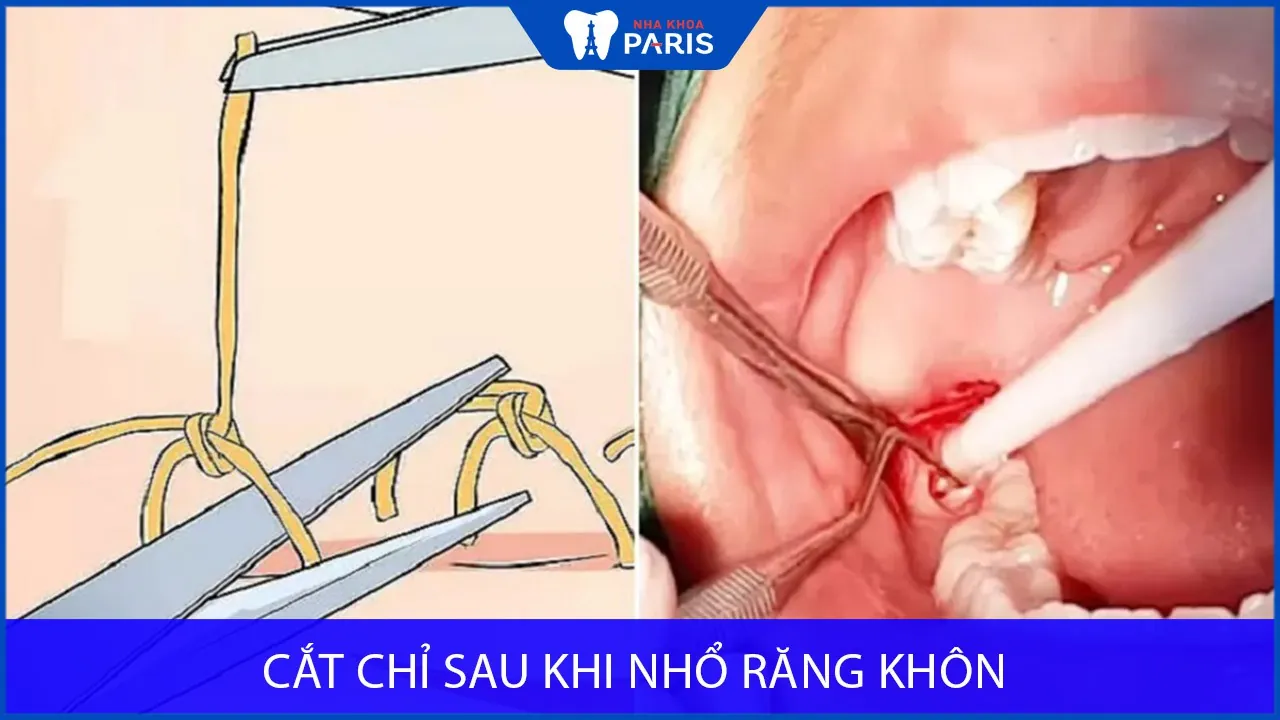 Cắt chỉ sau khi nhổ răng khôn: Cách thực hiện và các lưu ý cần biết