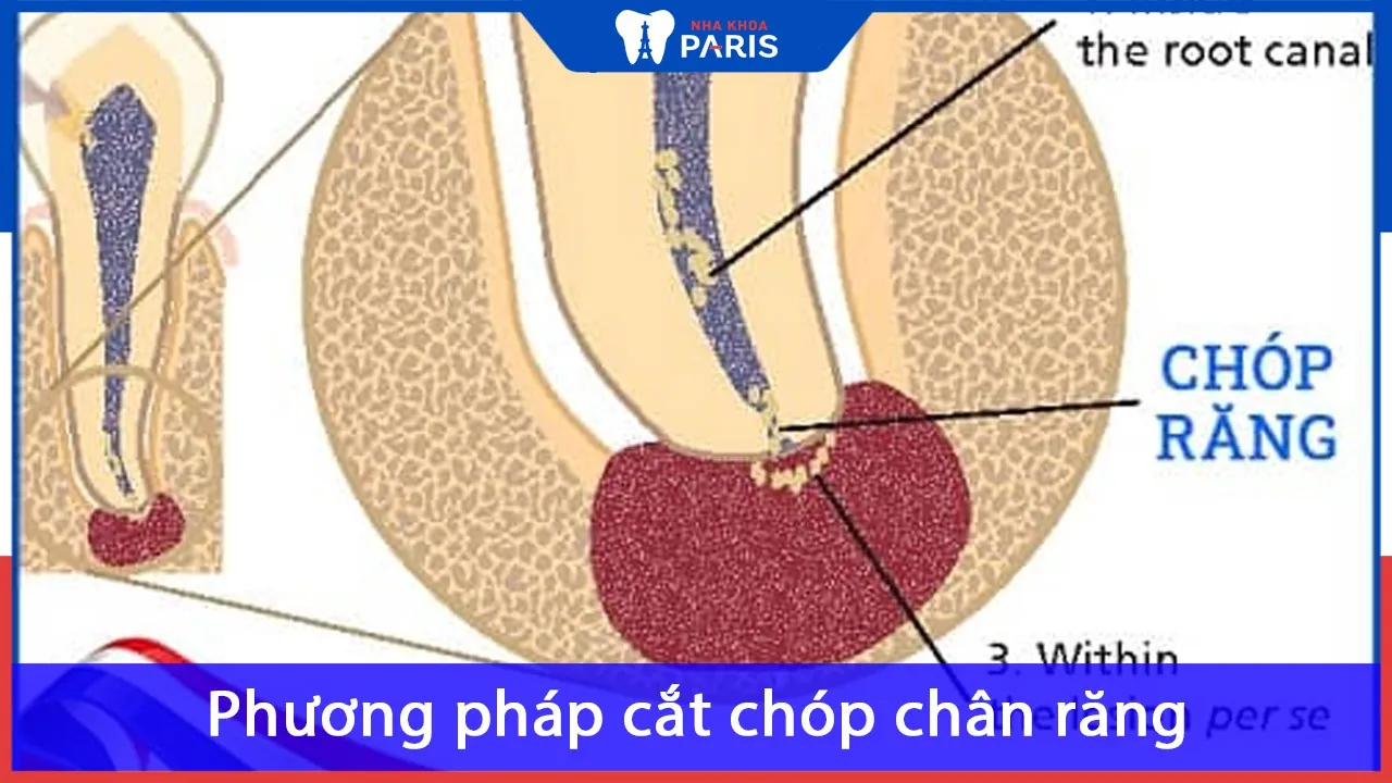 Phương pháp cắt chóp chân răng – Giải pháp cho vấn đề răng nhọn