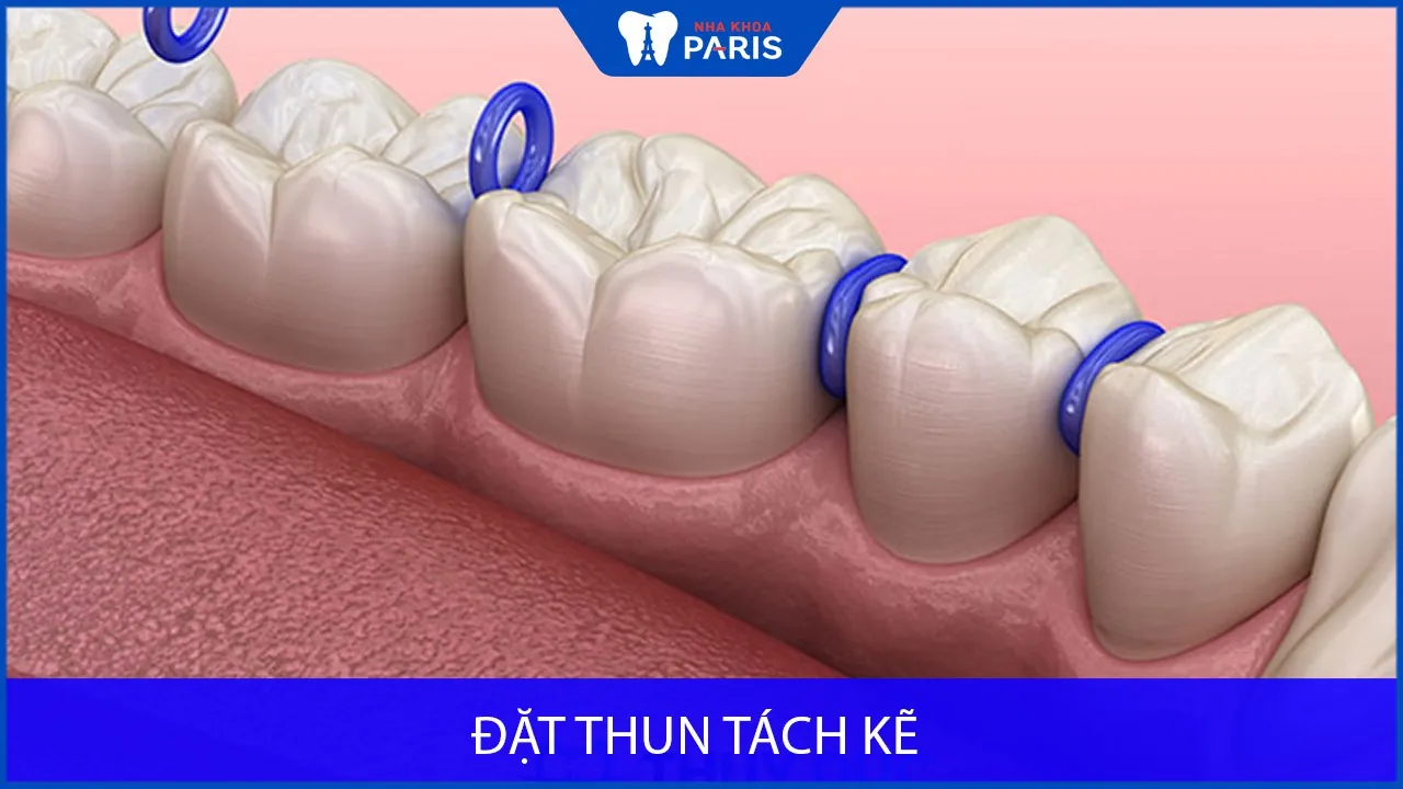 Đặt thun tách kẽ: Cải thiện tình trạng răng đan xen với thun tách kẽ