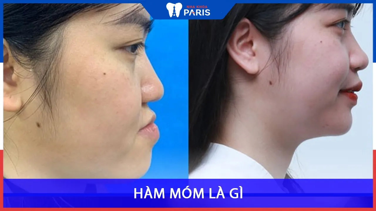 Hàm móm là gì | Phẫu thuật chỉnh hàm móm giá bao nhiêu