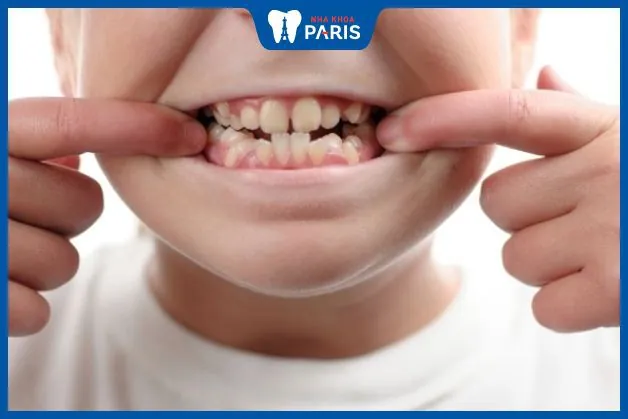Bé mọc răng khểnh: các dấu hiệu và cách giúp bé giảm đau
