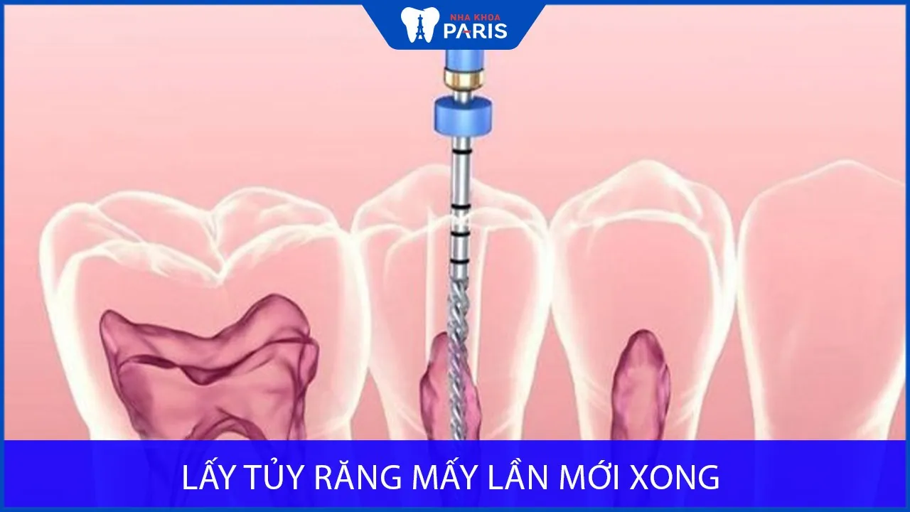 Lấy tủy răng mấy lần mới xong? Lưu ý quan trọng