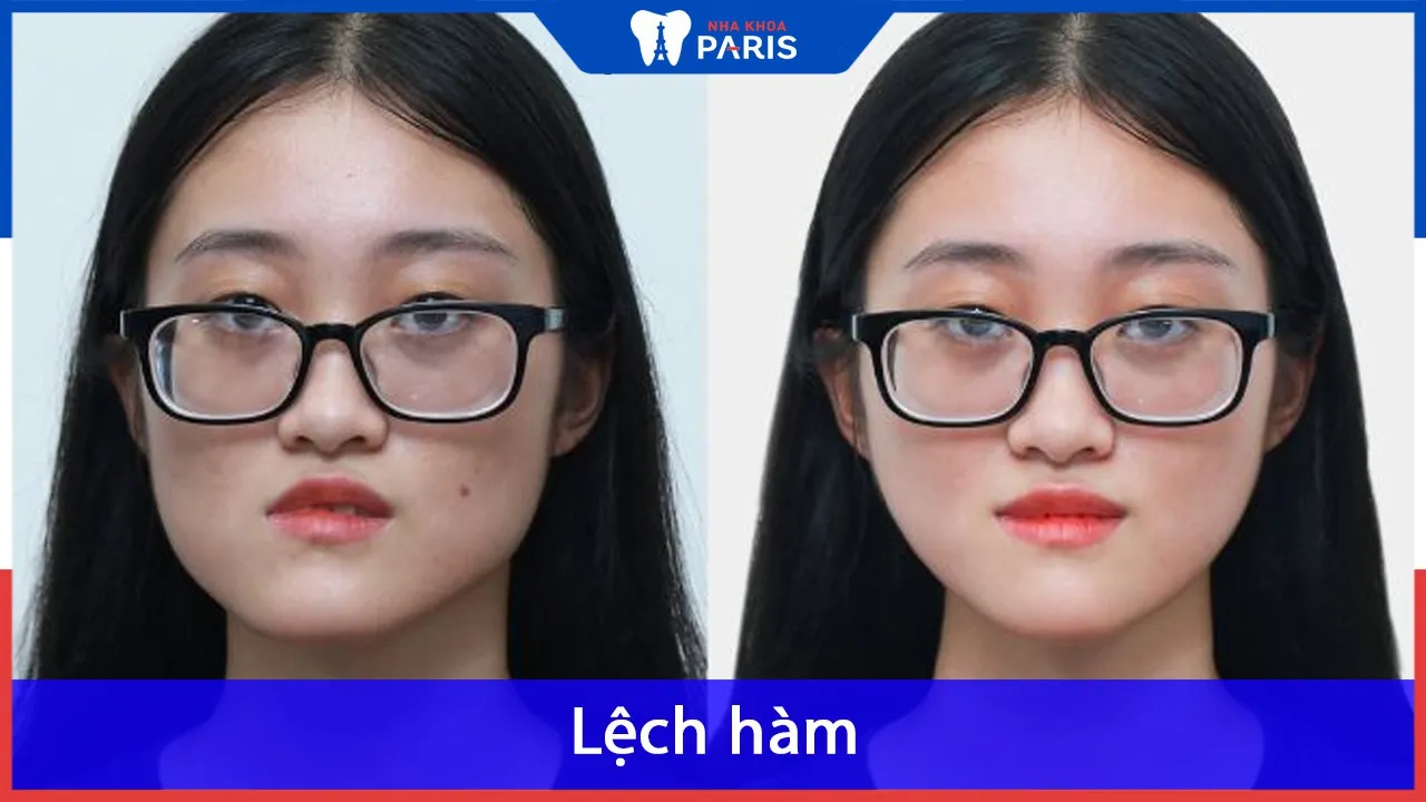 Lệch hàm: nguyên nhân, triệu chứng và phương pháp điều trị