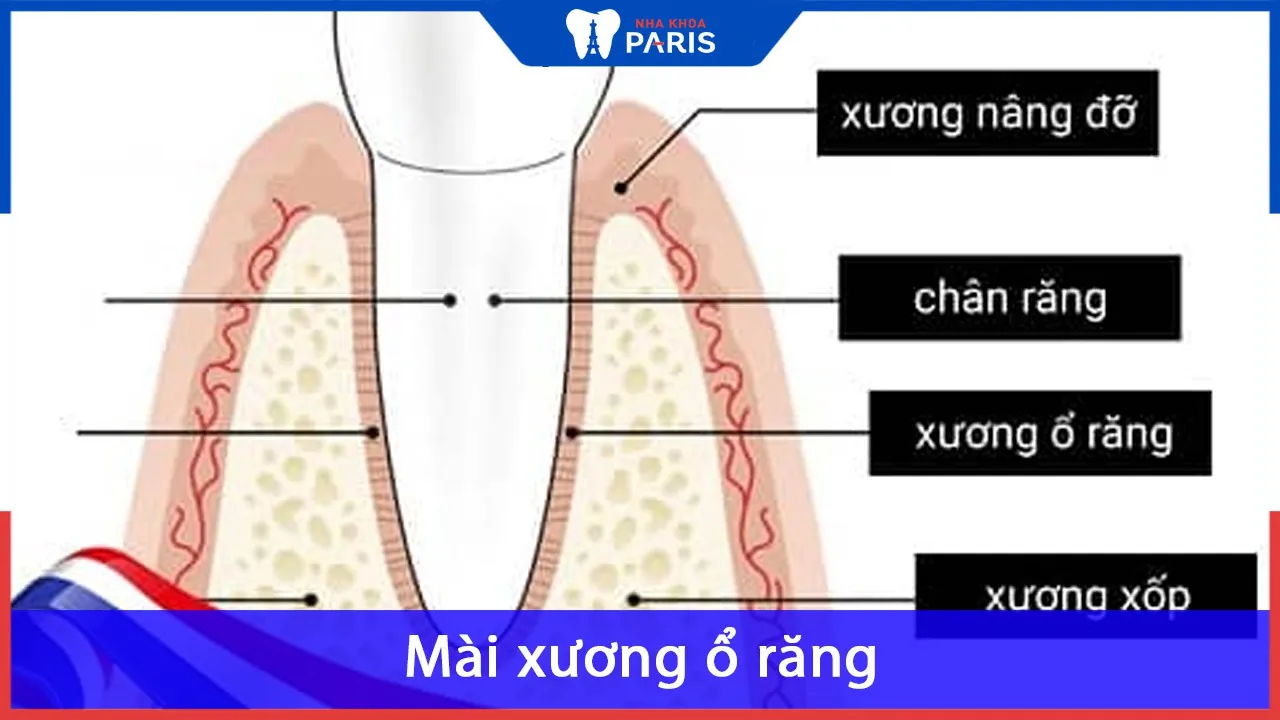 Mài xương ổ răng: Giảm đau và cải thiện chức năng ăn nhai