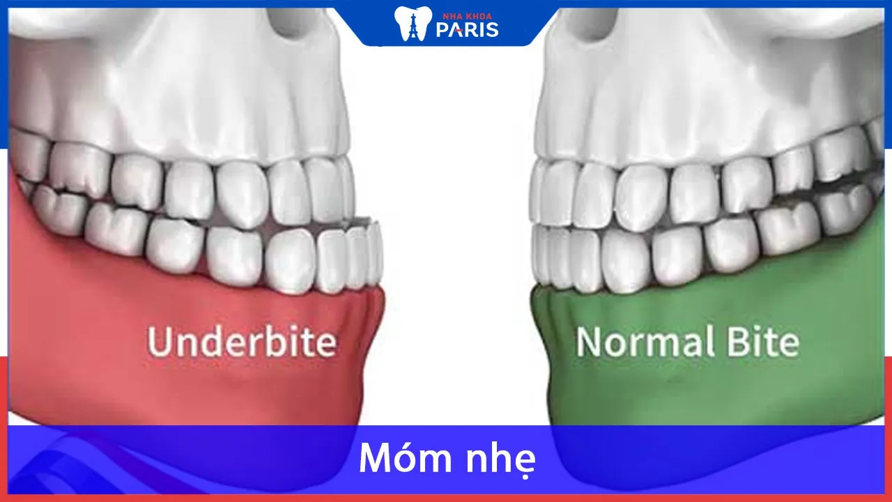 Móm nhẹ: Tìm hiểu rõ nguyên nhân và cách khắc phục