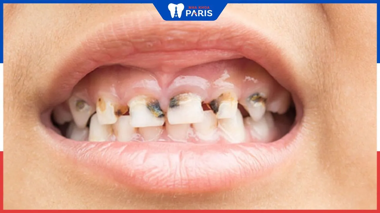 Nhổ răng sữa bị sún cho bé được không? Tìm hiểu rõ vấn đề