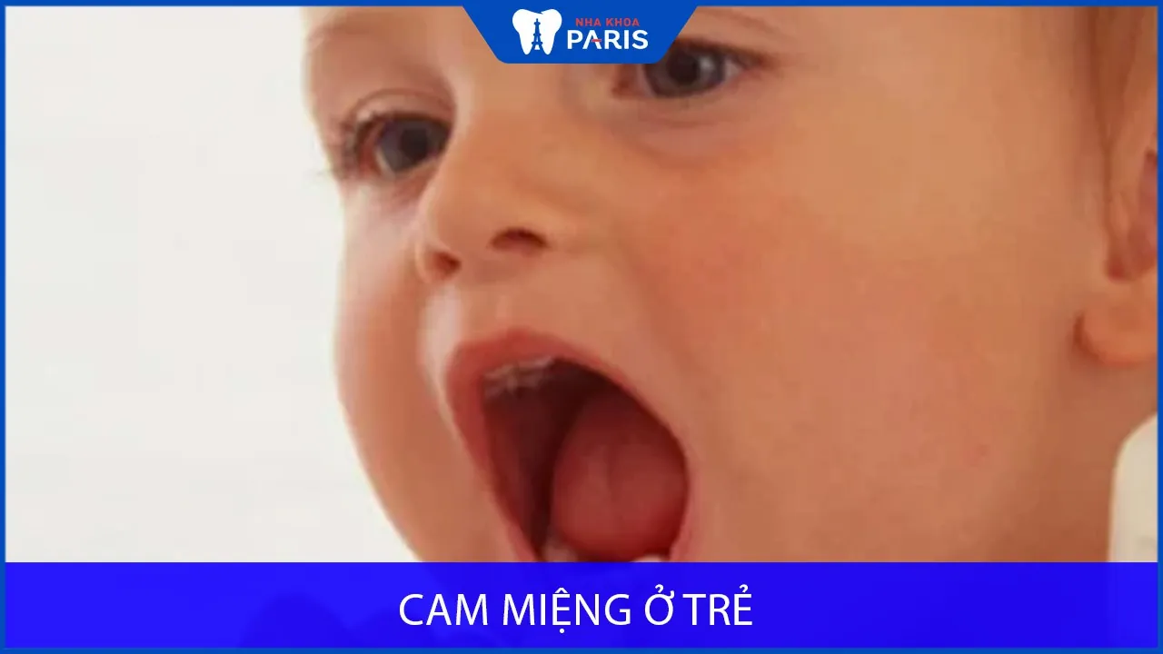 Cam miệng ở trẻ: Nguyên nhân, triệu chứng và cách điều trị