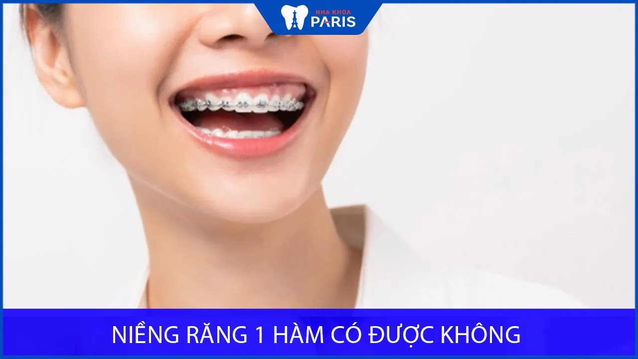 Niềng răng 1 hàm có được không? Giá niềng răng 1 hàm