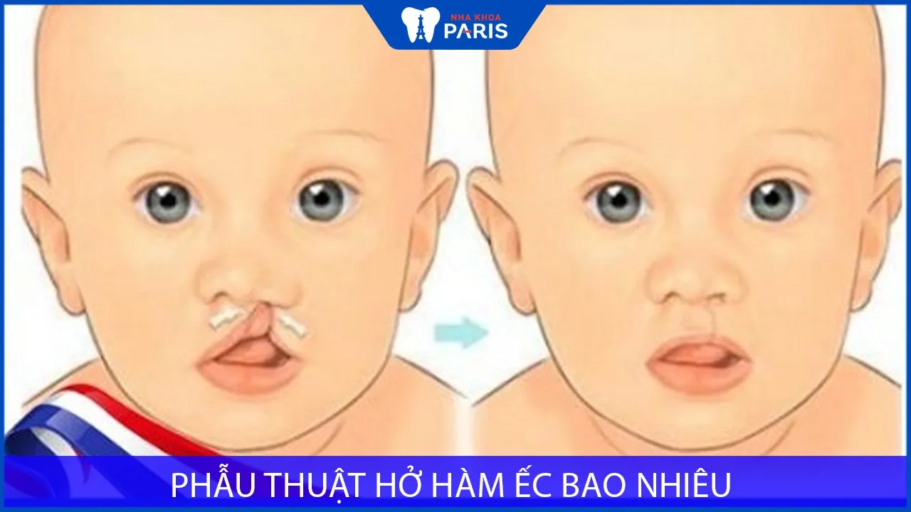 Chi phí cho phẫu thuật hở hàm ếch là bao nhiêu