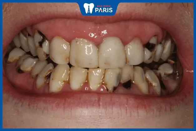 Răng cửa lung lay có nên nhổ không? Trường hợp nào cần nhổ