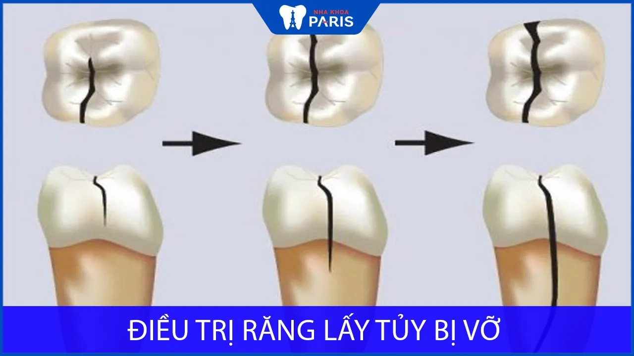Điều trị răng lấy tủy bị vỡ: Nguy hiểm và cách khắc phục