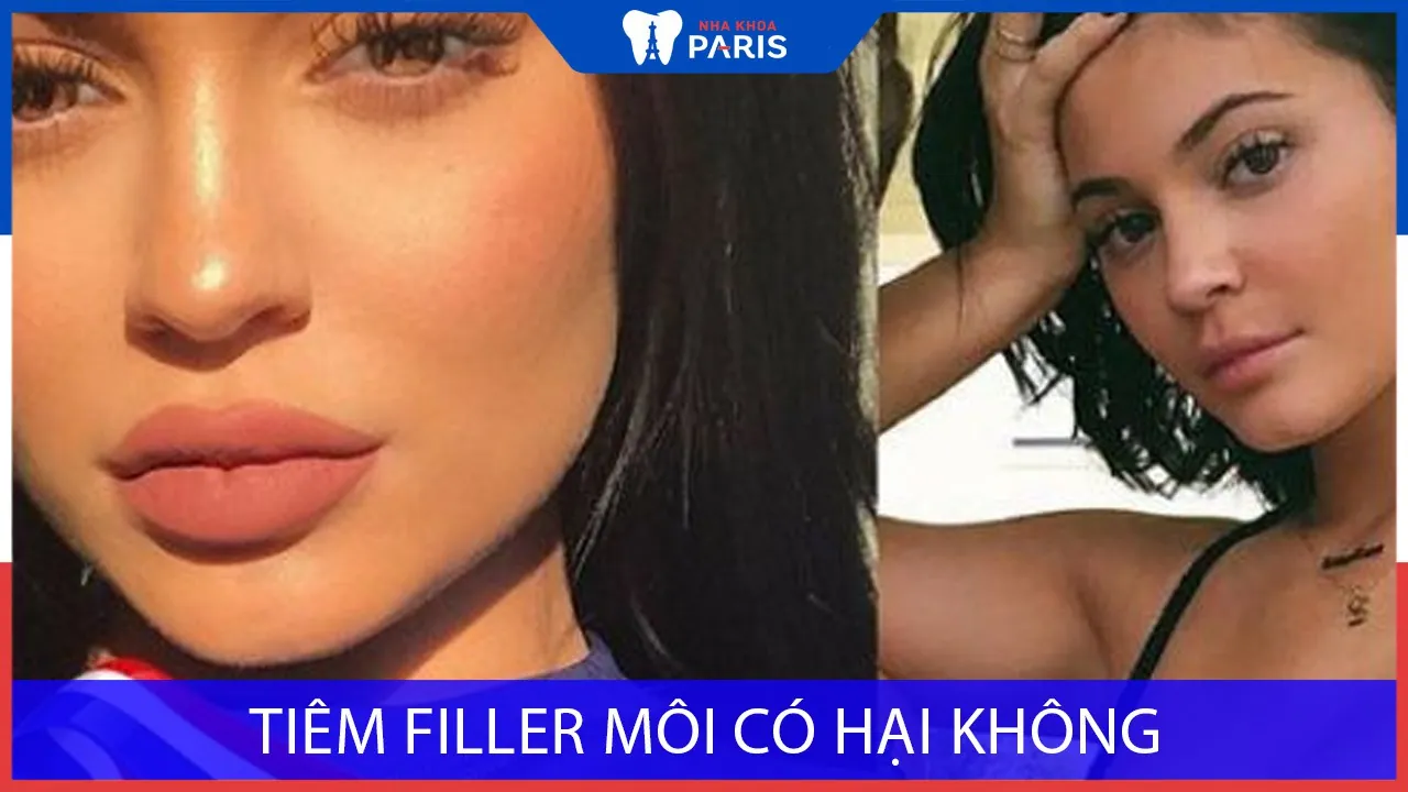 Tiêm filler môi có hại không? Một số lưu ý hạn chế
