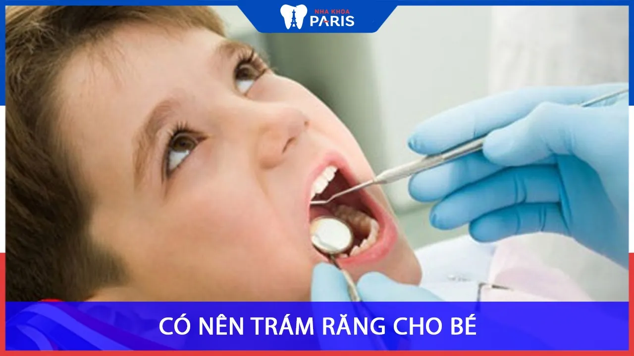 Có nên trám răng cho bé hay không- Lưu ý quan trọng
