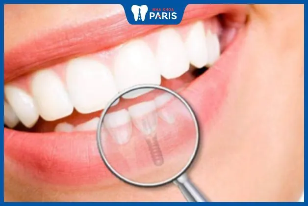 Các phương pháp trồng răng cửa hiệu quả cho hàm dưới