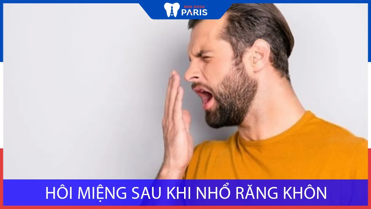 Hôi miệng sau khi nhổ răng khôn: Nguyên nhân và cách điều trị